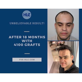 Hairline Clinic Instagram